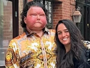 Dünya’da birinci defa birebir bireyden hem yüz hem de çift el nakli yapılan adam nişanlandı